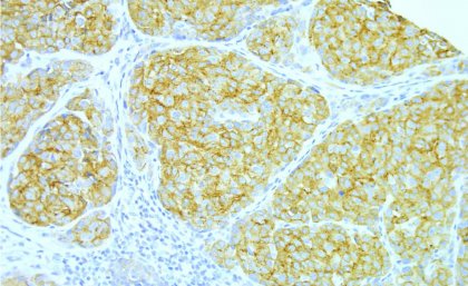 Areas containing RAB27A molecules (brown staining) within a section of a melanoma.